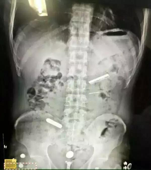 吸毒吞刀片为什么不会被抓,吸毒吞刀片啥意思