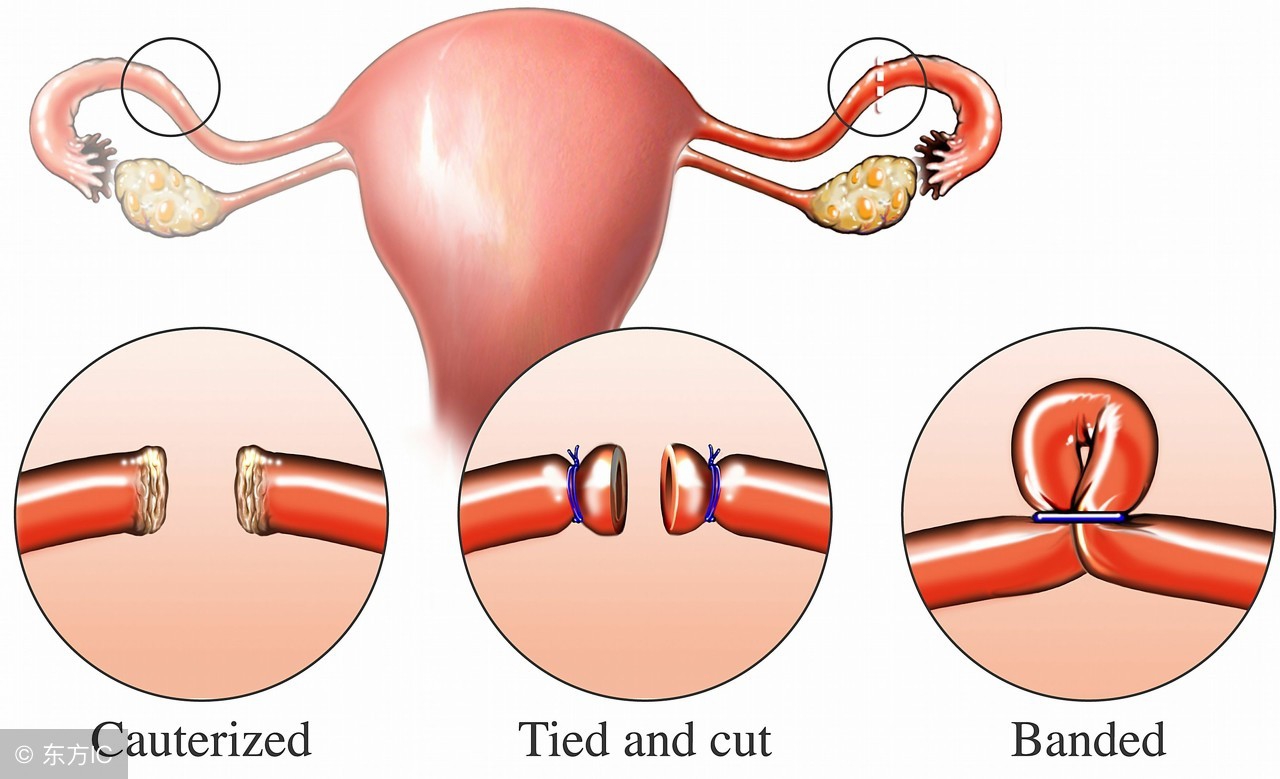 结扎是男的做的还是女的,结扎是男性好还是女性好