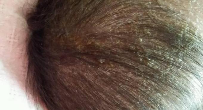 宝宝去奶痂,宝宝乳痂的正确处理方法文库