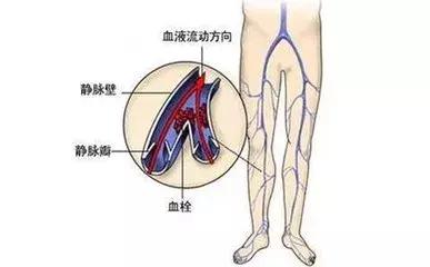 关于深静脉血栓，你要知道的几点。