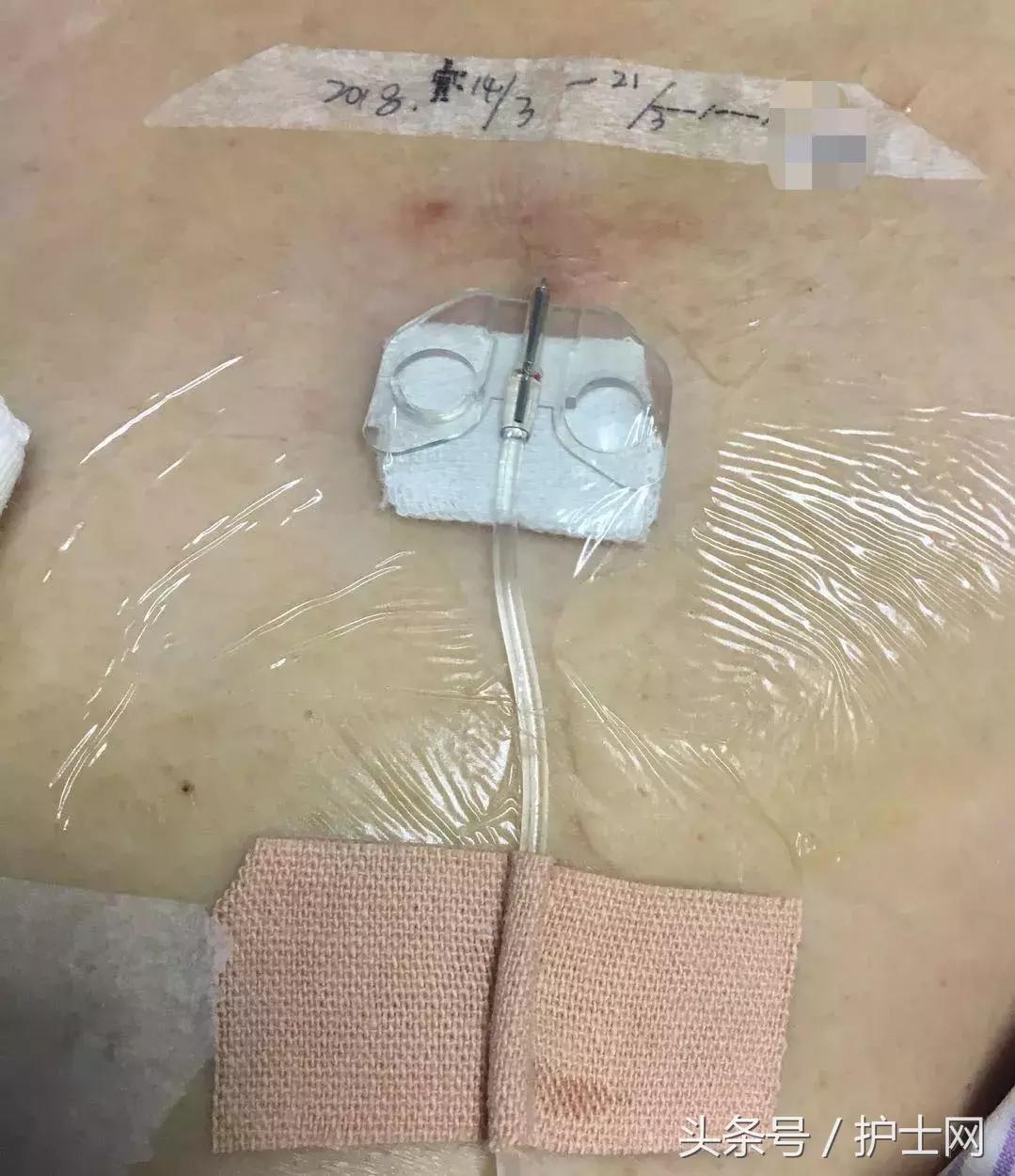 输液港扎针最全示范,输液港拔针的正确方法视频教程