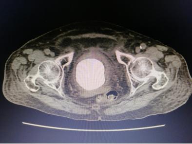 86岁老人膀胱结石建议手术吗,膀胱结石93岁老人