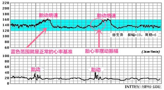 35周胎心监护宫缩值多少算正常,孕35周脐绕颈一周胎心监护不过