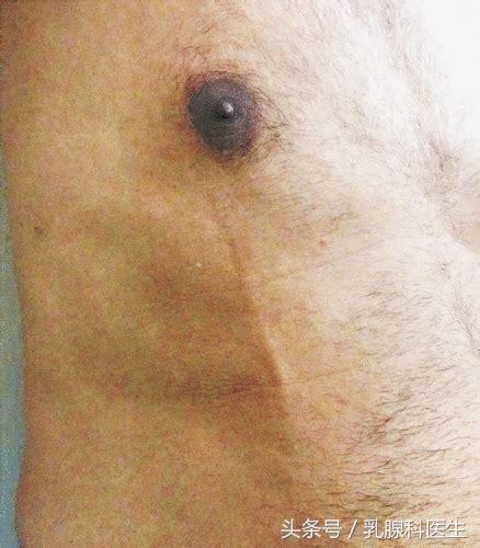 乳腺增生、乳腺炎、乳腺癌会发生在男人身上吗？