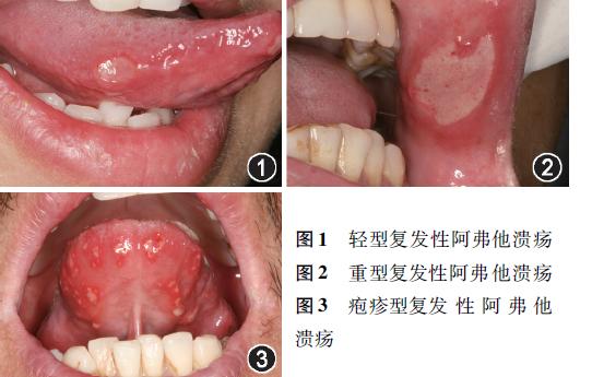牙疼伴有口腔溃疡服用什么药物,小朋友口腔溃疡应该选择什么药物