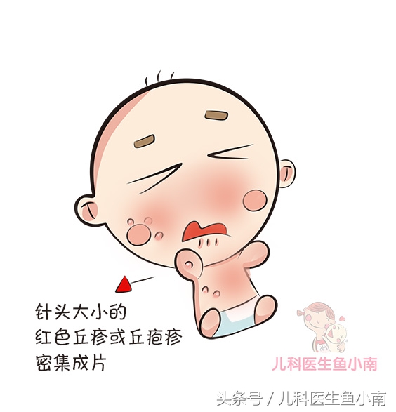 宝宝湿疹热疹区别,宝宝湿疹和热疹怎么观察