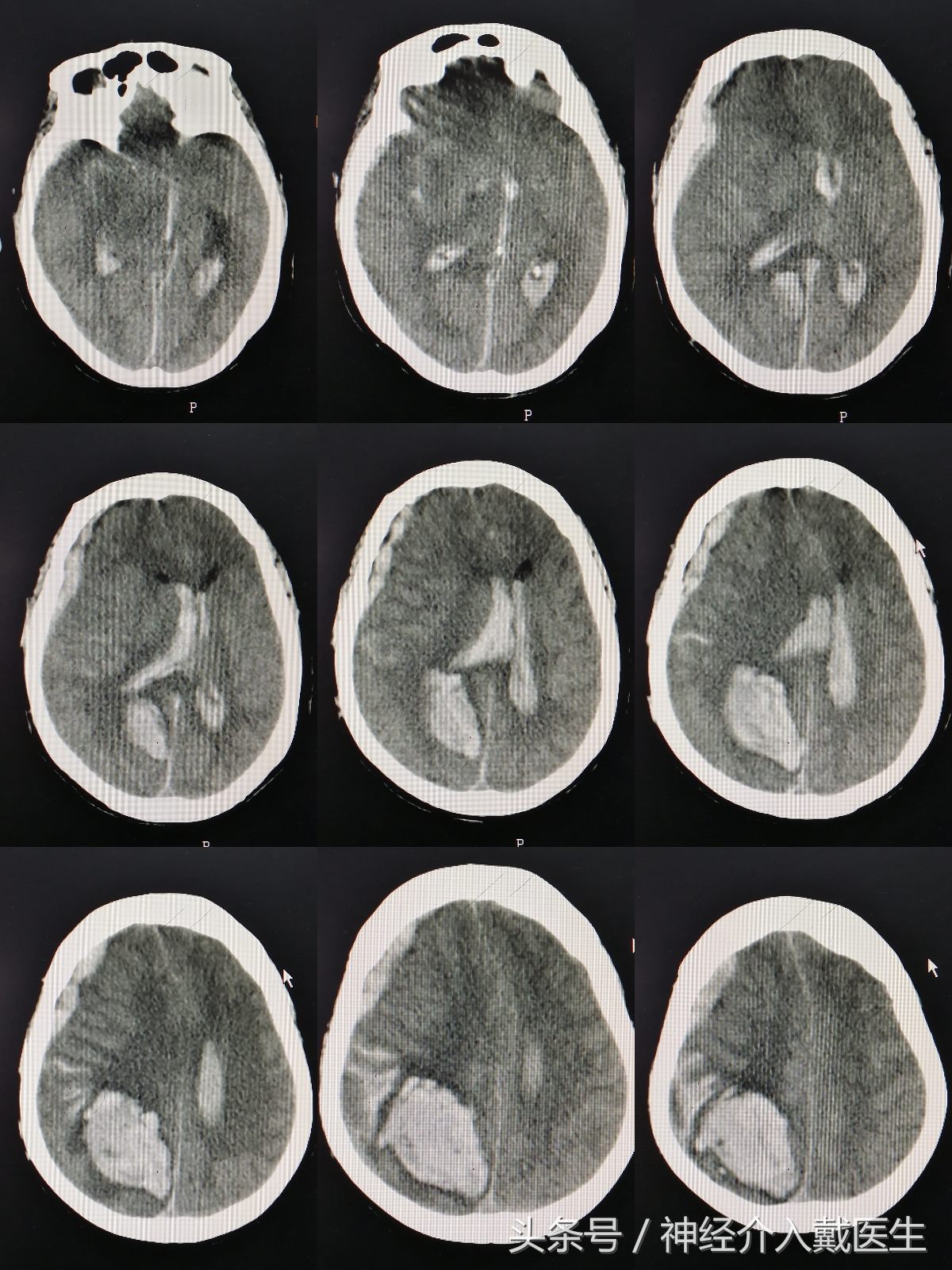 脑出血100ml有奇迹吗,脑出血后遗症奇迹痊愈