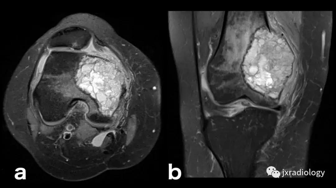 磁共振骶髂关节骨髓水肿是强直吗,磁共振显示骨髓水肿什么意思