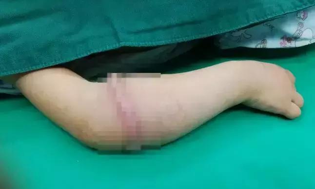 四岁女孩手臂上长肉环,4岁女童手臂取出肉环