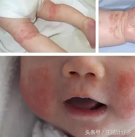 宝宝湿疹反反复复不好怎么办,宝宝湿疹反复干预