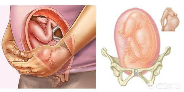 什么是浅入盆和完全入盆,浅入盆代表胎位正吗