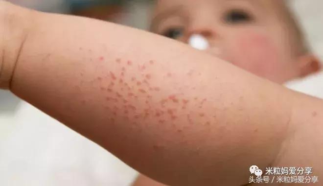 宝宝起疹的最佳治疗方法,孩子发烧后出疹怎么护理