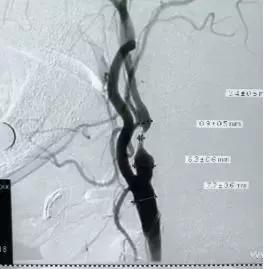 西安市第三人民医院血管外科,治疗颈动脉斑块西安哪家医院好