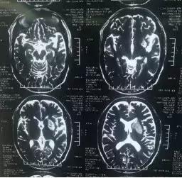 西安市第三人民医院血管外科,治疗颈动脉斑块西安哪家医院好