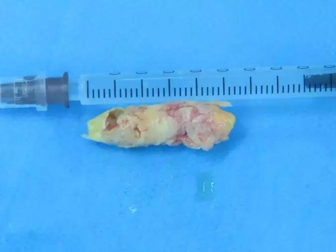 西安市第三人民医院血管外科,治疗颈动脉斑块西安哪家医院好