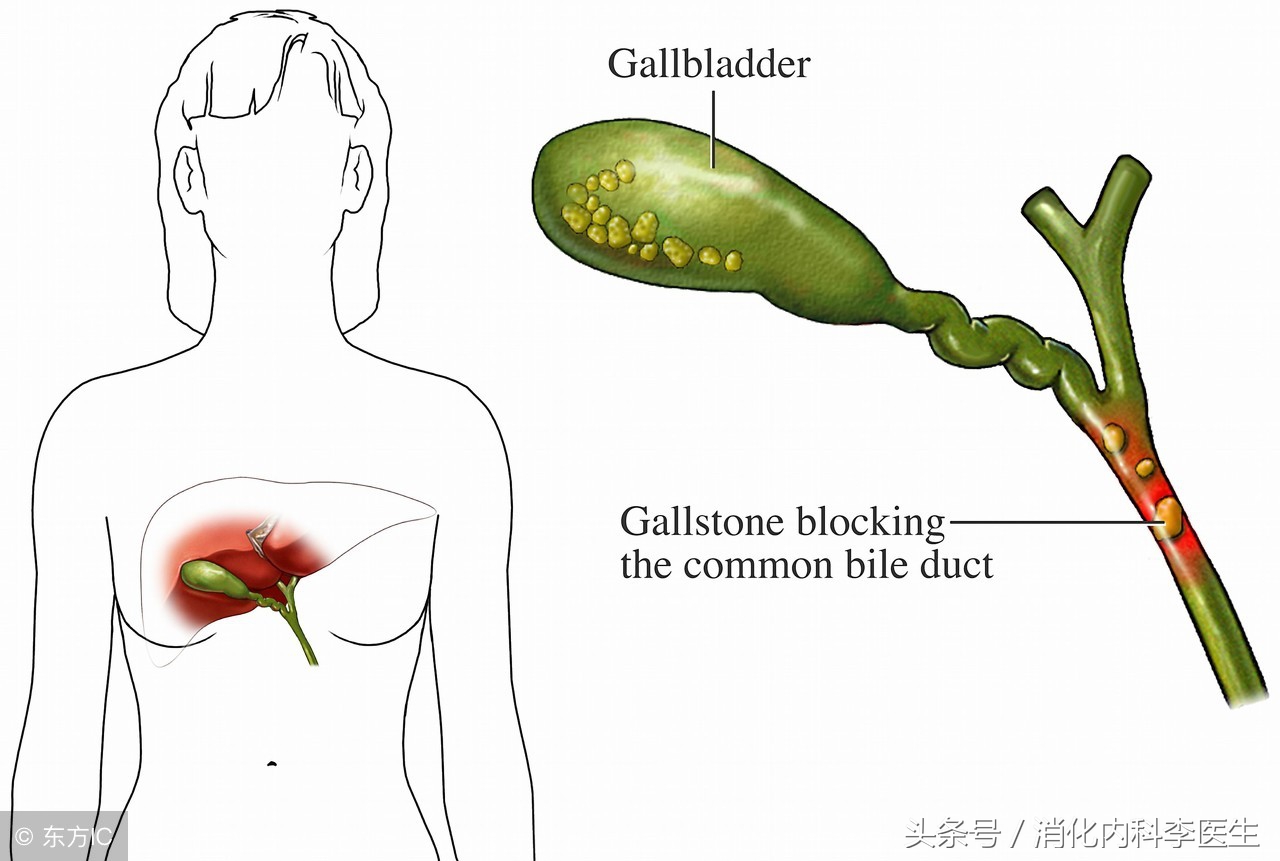 胆结石在消化内科怎么治疗,胆结石挂消化内科还是肝胆外科
