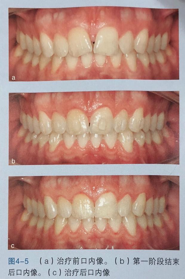 牙齿上的黑三角怎么去除,去除牙齿黑三角的神器
