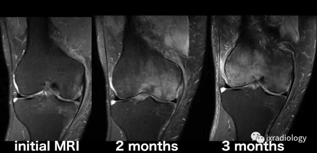 膝关节骨髓水肿疼痛特点,膝关节骨髓水肿的临床表现