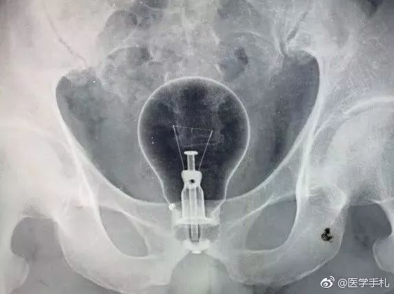 灯泡进肛门引发万人关注，“会诊”结果靠谱么？