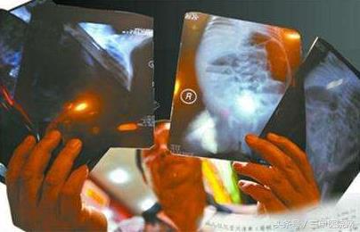 先天性巨结肠：越治越坏的腹泻患儿6个月内死亡率高达50%-70%