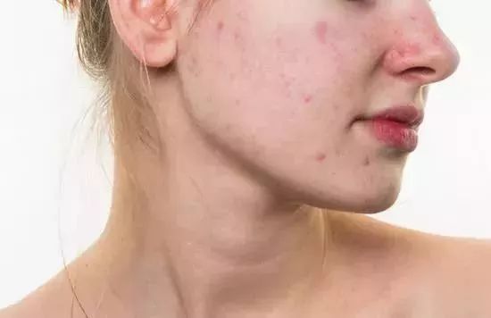怎样消除痘印食疗,青春期痘印怎么消除小妙招