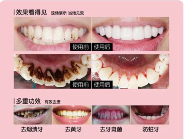 牙齿美白慕斯真的好用吗,牙齿美白慕斯真的好吗