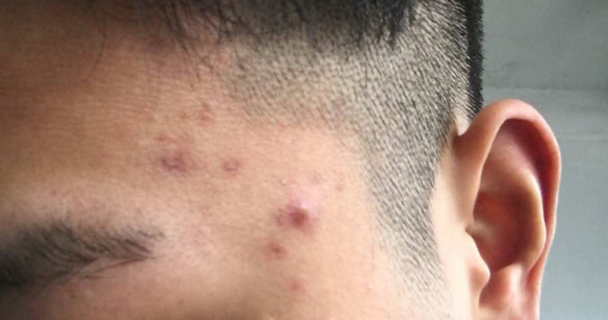 远离痘痘肌和痘痘说拜拜淡化痘印,痘痘肌怎么祛痘印最有效的方法