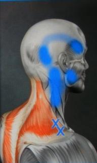 肌筋膜触发点是痛点么,筋膜球能疏通激痛点吗