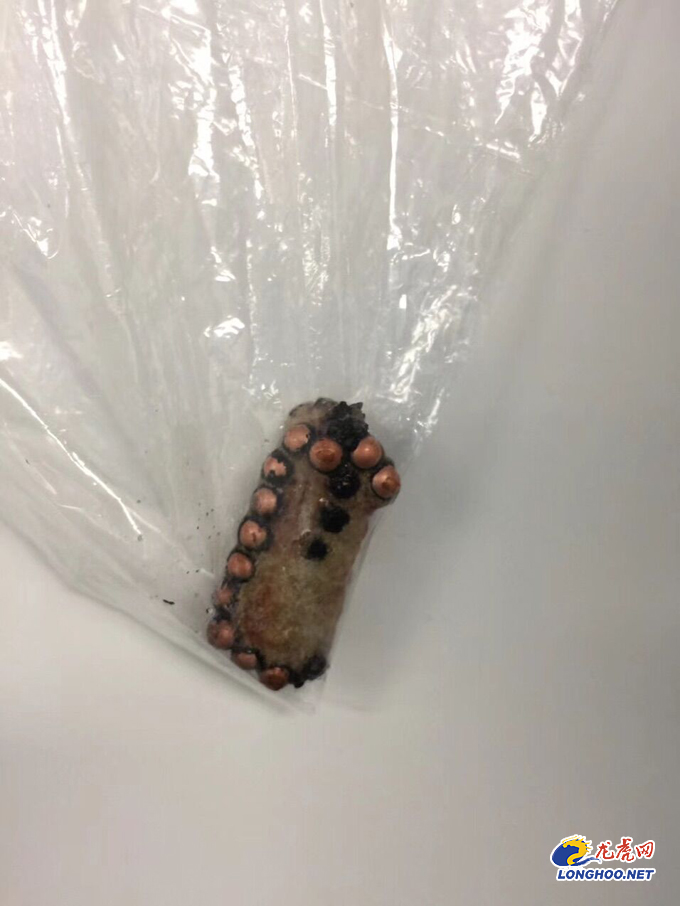 一男孩膀胱里发现184颗磁珠,男童膀胱取出19粒磁珠原因