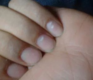 看指甲识健康,从指甲看疾病的图片说明