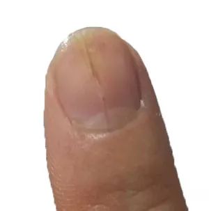 看指甲识健康,从指甲看疾病的图片说明