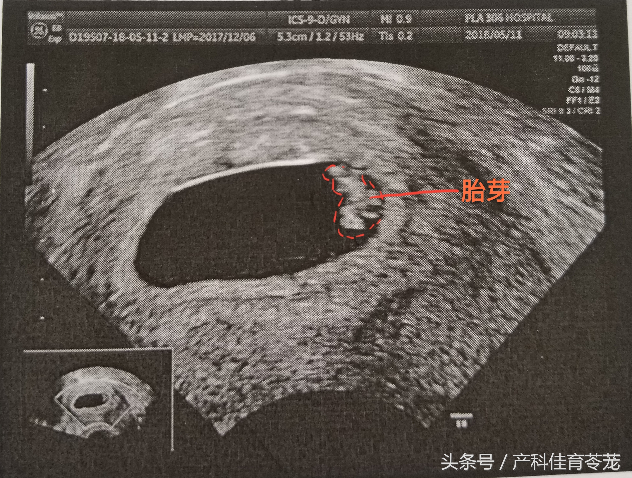 孕期B超数据准确吗,b超医生说的数字