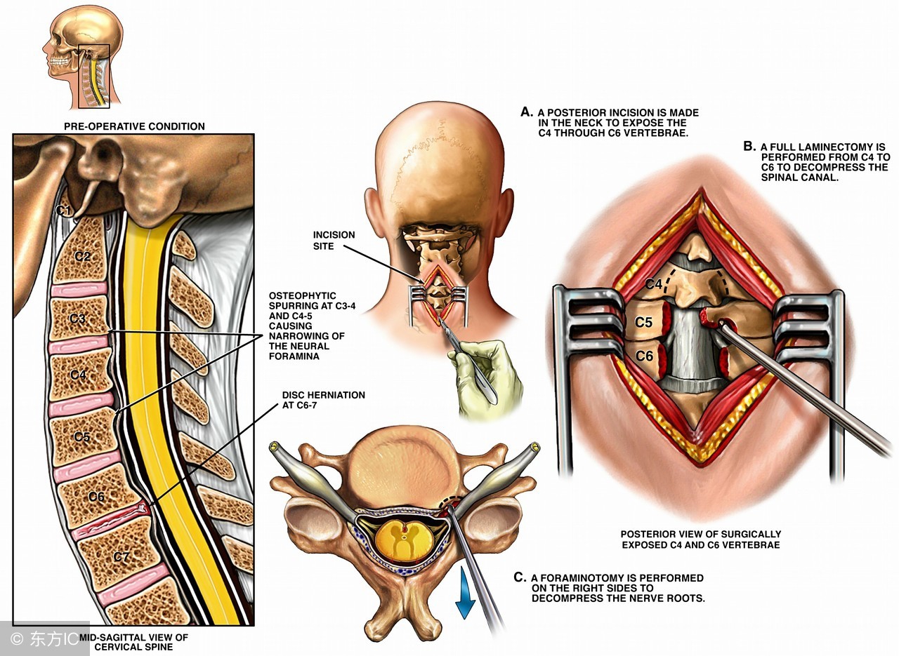 膝盖骨质增生的克星草药,膝关节骨质增生的克星