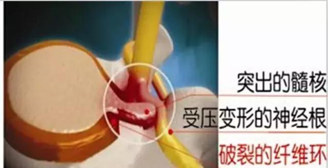 预防颈椎腰椎间盘突出的健身操,办公室预防腰椎间盘突出锻炼方法