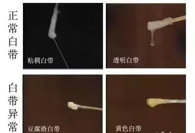 下身白带多黏黏的是怎么回事,下身老是有黏黏的白带