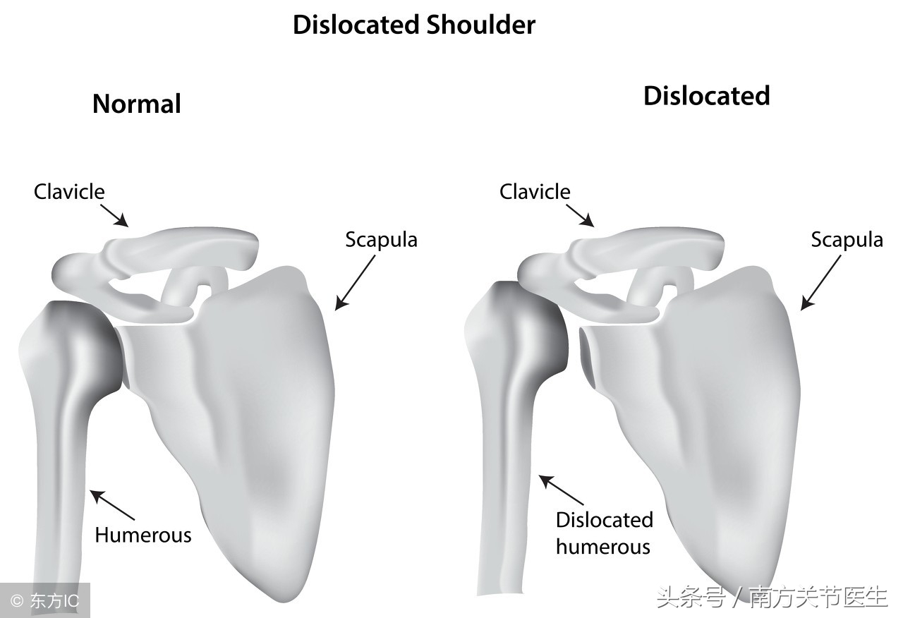 小孩脱臼以后有影响吗,小孩脱臼后会经常脱臼吗