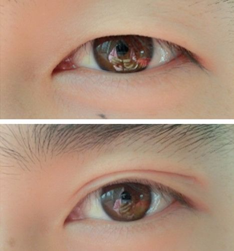 经常贴双眼皮贴上眼皮松弛怎么办,贴双眼皮贴怎样避免眼皮松弛