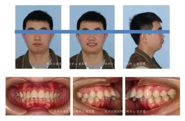 原来，上牙盖住下牙太多，也对牙齿有伤害！该怎么矫正？