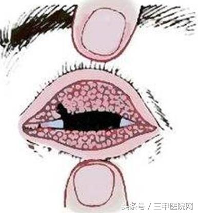 沙眼不治的后果是什么,沙眼要去眼科医院治疗吗