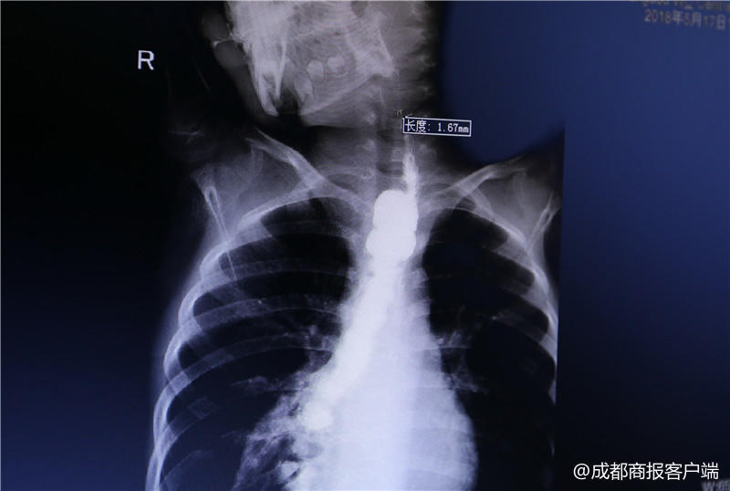 误食强碱灼伤食道后续,误食强碱灼伤食道的后果