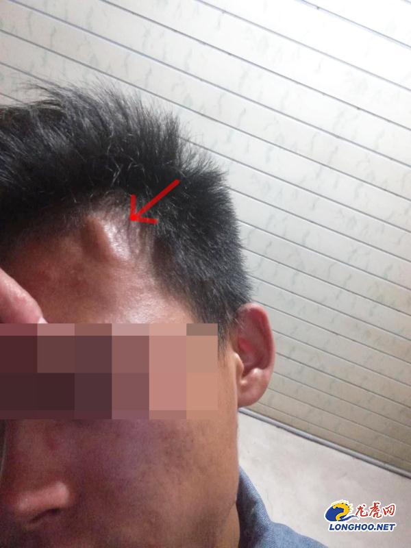 小伙查出来脑袋长肿瘤,男子脑袋里长了肿瘤