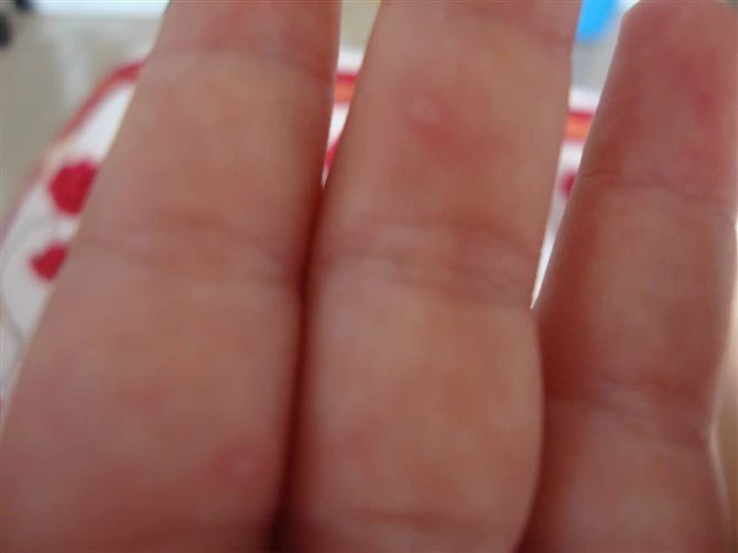 预防手足口病,预防手足口病儿歌