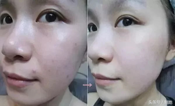 脸上痘印和红痘最佳消灭法,战痘神器工具
