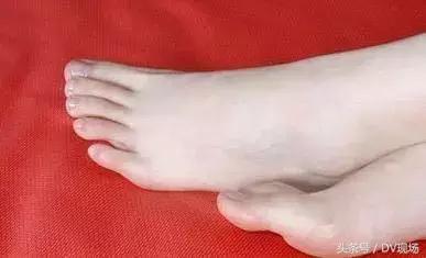 八旬老太脚趾溃破、发黑，皆因治脚气时用这个泡脚！