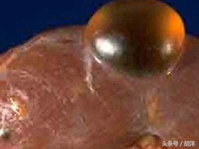 囊肿跟肿瘤的影像学区别,囊肿和肝癌的关系