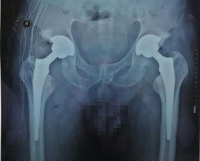 承德附属医院骨外科髋关节置换术,山西医大一院髋关节置换技术