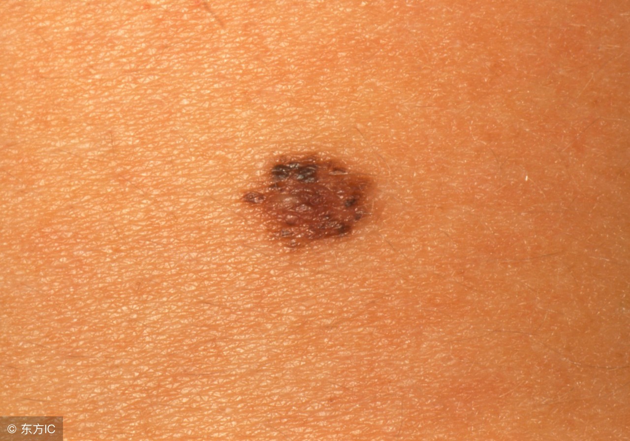 身上长红痣肝功能正常需要注意吗,皮肤上长红痣要当心是肝病的征兆