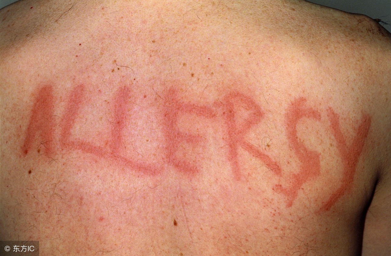 *麻疹荨**：拔罐还可以治疗*麻疹荨***麻疹荨**有哪些饮食禁忌？