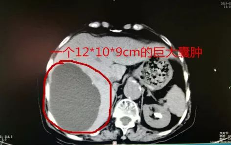 以为是肠胃小毛病没想到是癌症,开始以为是胃疼后来才发现是结石