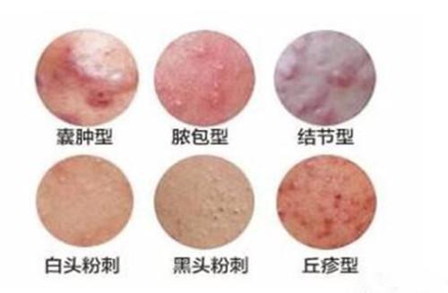 后背脖子上起很多痘痘怎么消除,脖子上长了一个大痘痘怎么消除